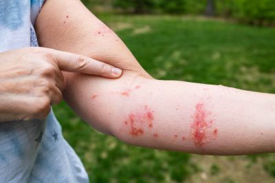 Remove Dangerous Poison Ivy!